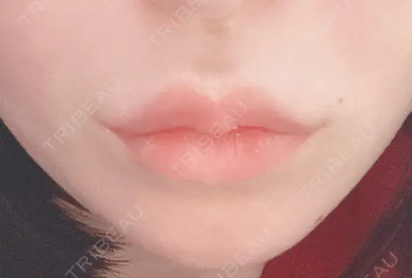 脂肪溶解注射（顔） / ヒアルロン酸注入（唇） ブルームクリニック（BLOOM CLINIC） DAY 0 メイン用