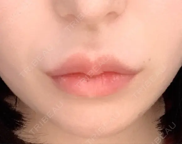 脂肪溶解注射（顔） / ヒアルロン酸注入（唇） ブルームクリニック（BLOOM CLINIC） AFTER メイン用
