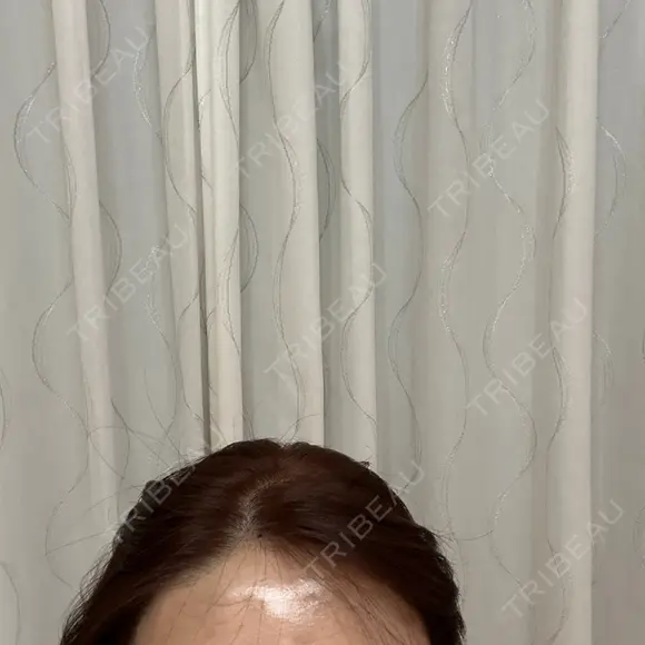 脂肪注入（額） Mods Clinic（モッズクリニック） 福岡院 DAY 0 メイン用