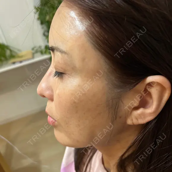 脂肪注入（額） Mods Clinic（モッズクリニック） 福岡院 DAY 0 メイン用