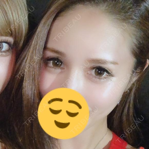 二重埋没 / 目尻切開 / タレ目形成・グラマラスライン（切開） プリモ麻布十番クリニック AFTER メイン用
