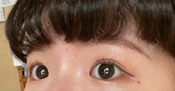 二重埋没 水の森美容クリニック 大阪梅田院 AFTER メイン用