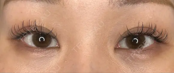 二重埋没 藤・ナチュレ美容クリニック 銀座院 AFTER メイン用