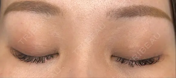 二重埋没 藤・ナチュレ美容クリニック 銀座院 DAY 33 メイン用