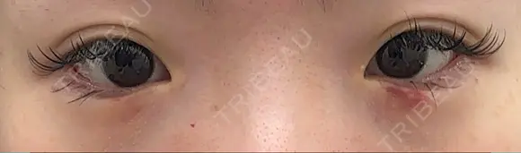 ヒアルロン酸注入（涙袋） ファイヤークリニック 新宿院 AFTER メイン用