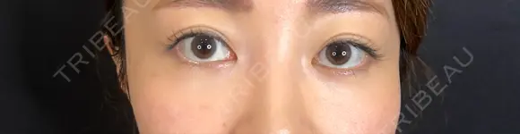 クマ治療 藤・ナチュレ美容クリニック 銀座院 AFTER メイン用
