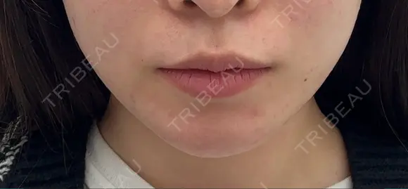 ボトックス（エラ・小顔） / その他（輪郭） L‘amour clinic Tokyo【ラムールクリニック東京】 AFTER メイン用