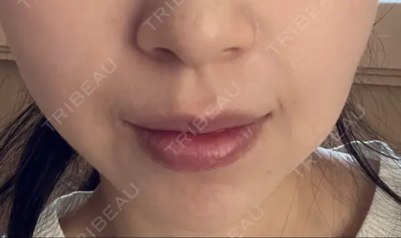 ヒアルロン酸注入（鼻翼基部） ルラ美容クリニック 名古屋本院 DAY 5 メイン用