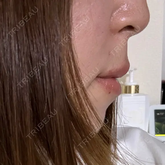 ヒアルロン酸注入（唇） / ボトックス（口角） / ヒアルロン酸注入（頬） / イオン導入 / ルメッカ ルラ美容クリニック 大宮院 / ルラスキンクリニック 大宮院 AFTER メイン用