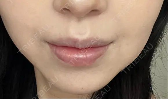 ヒアルロン酸注入（鼻翼基部） ルラ美容クリニック 名古屋本院 DAY 6 メイン用