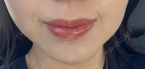 ヒアルロン酸注入（鼻翼基部） ルラ美容クリニック 名古屋本院 DAY 7 メイン用