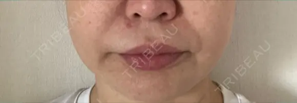 ボトックス（口角） / ボトックス（人中） S-Laboクリニック 渋谷院 DAY 6 メイン用
