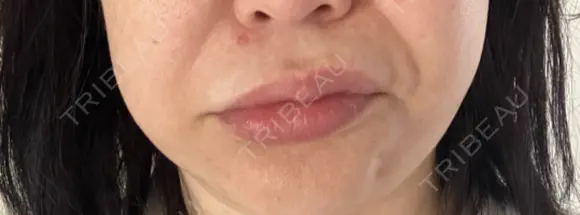 ボトックス（口角） / ボトックス（人中） S-Laboクリニック 渋谷院 DAY 7 メイン用