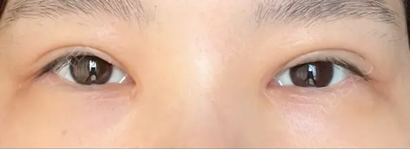 二重切開 / 目頭切開 / 上まぶたたるみ取り 湘南美容クリニック 大阪堺東院 DAY 93 メイン用