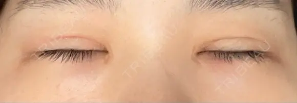 二重切開 / 目頭切開 / 上まぶたたるみ取り 湘南美容クリニック 大阪堺東院 DAY 93 メイン用