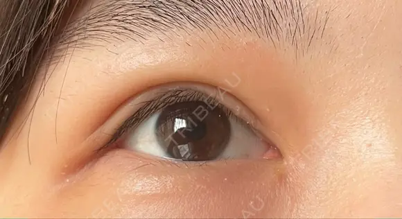 二重切開 / 目頭切開 / 上まぶたたるみ取り 湘南美容クリニック 大阪堺東院 DAY 93 メイン用