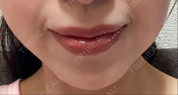 ヒアルロン酸注入（鼻翼基部） ルラ美容クリニック 名古屋本院 DAY 8 メイン用