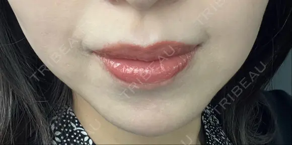 ヒアルロン酸注入（鼻翼基部） ルラ美容クリニック 名古屋本院 DAY 9 メイン用