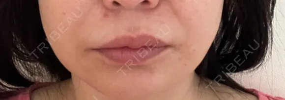 ボトックス（口角） / ボトックス（人中） S-Laboクリニック 渋谷院 DAY 8 メイン用