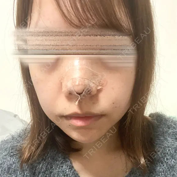 鼻尖形成（切開） / 軟骨移植 / ヒアルロン酸注入（鼻） / ヒアルロン酸注入（あご） ASTRA BEAUTY CLINIC DAY 2 メイン用