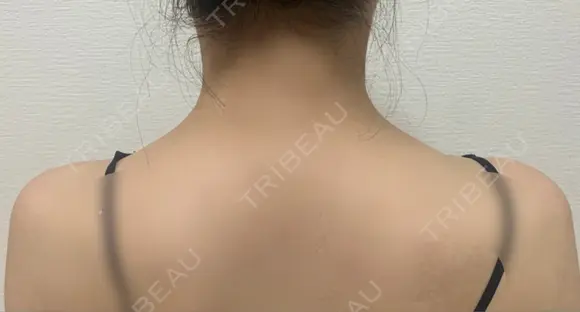 ボトックス（肩） / ボトックス（眉間） / ボトックス（額） ルラ美容クリニック 大阪本院 AFTER メイン用