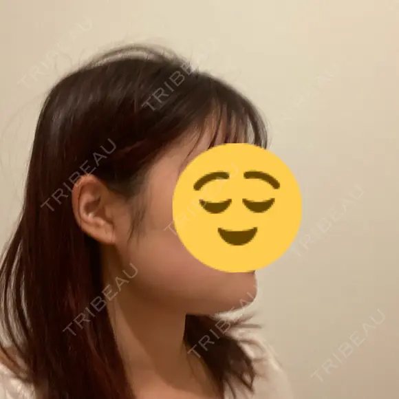 脂肪吸引（顔） / ボトックス（エラ・小顔） ネビュラクリニック 京都院 DAY 3 メイン用