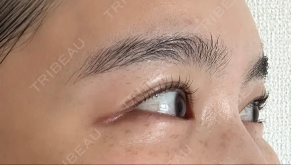 ボトックス（目尻） スキンリファインクリニック銀座 DAY 16 メイン用