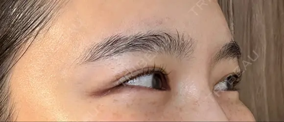 ボトックス（目尻） スキンリファインクリニック銀座 DAY 17 メイン用