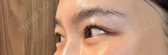 ボトックス（目尻） スキンリファインクリニック銀座 DAY 17 メイン用