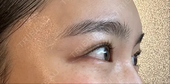 ボトックス（目尻） スキンリファインクリニック銀座 DAY 18 メイン用