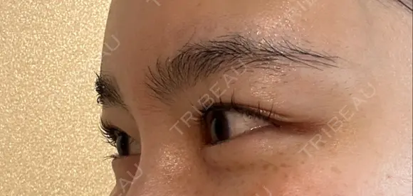 ボトックス（目尻） スキンリファインクリニック銀座 DAY 18 メイン用