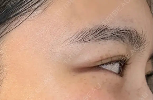 ボトックス（目尻） スキンリファインクリニック銀座 DAY 19 メイン用