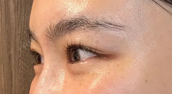 ボトックス（目尻） スキンリファインクリニック銀座 DAY 19 メイン用