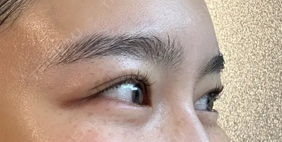 ボトックス（目尻） スキンリファインクリニック銀座 AFTER メイン用