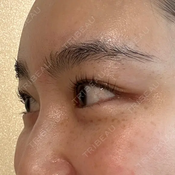 ボトックス（目尻） スキンリファインクリニック銀座 DAY 20 メイン用