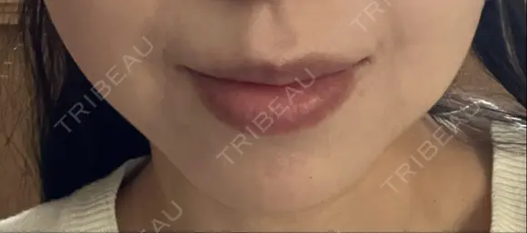 ヒアルロン酸注入（鼻翼基部） ルラ美容クリニック 名古屋本院 DAY 10 メイン用