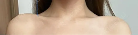 ボトックス（肩） 日比谷セントラルクリニック DAY 1 メイン用