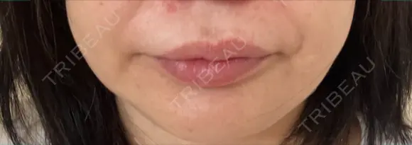 ボトックス（口角） / ボトックス（人中） S-Laboクリニック 渋谷院 DAY 9 メイン用