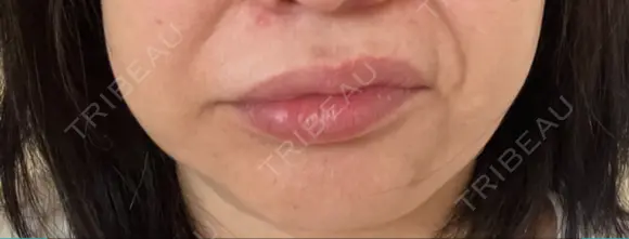 ボトックス（口角） / ボトックス（人中） S-Laboクリニック 渋谷院 DAY 9 メイン用