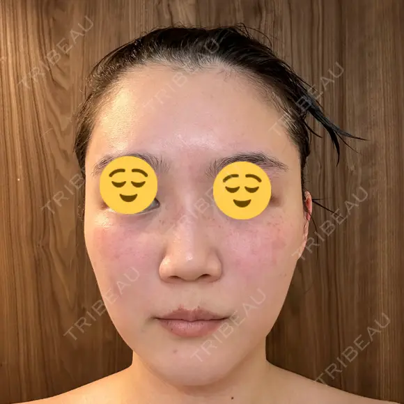 エレクトロポレーション 湘南美容クリニック Regno 銀座院 DAY 3 メイン用