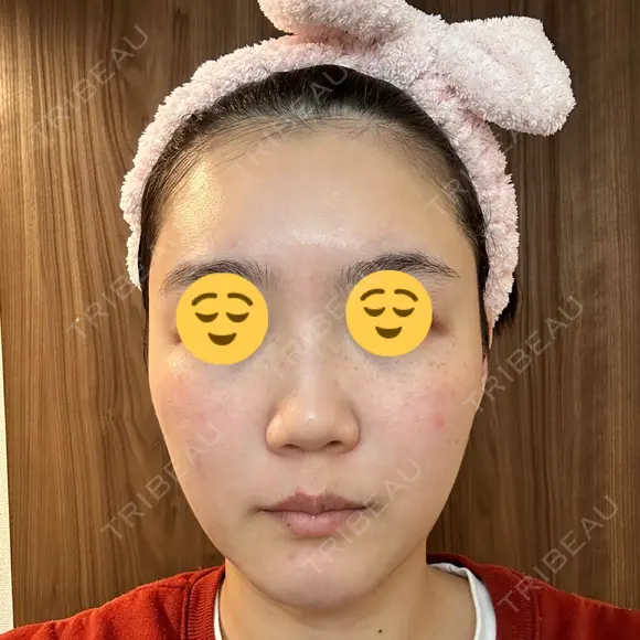 エレクトロポレーション 湘南美容クリニック Regno 銀座院 DAY 4 メイン用