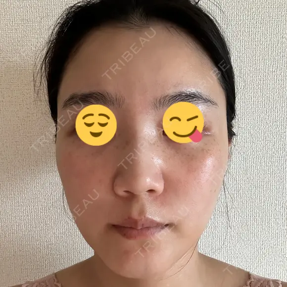 エレクトロポレーション 湘南美容クリニック Regno 銀座院 DAY 5 メイン用