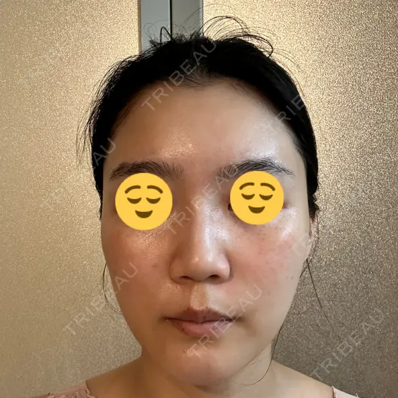 エレクトロポレーション 湘南美容クリニック Regno 銀座院 DAY 7 メイン用