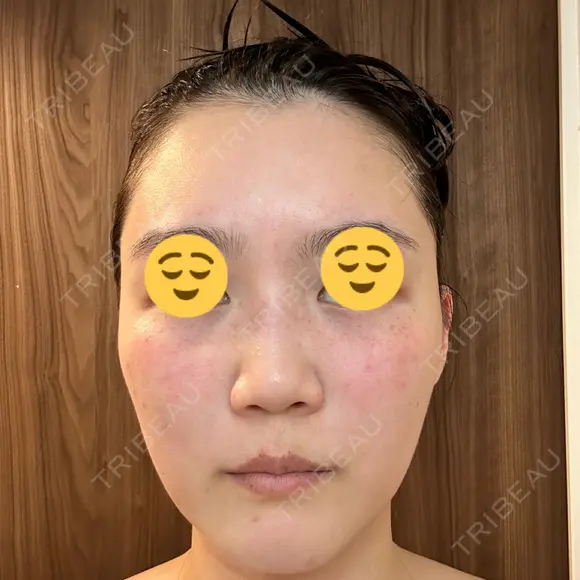 エレクトロポレーション / 光治療（フォトフェイシャルなど） DMTC CLINIC 日本橋院 DAY 3 メイン用