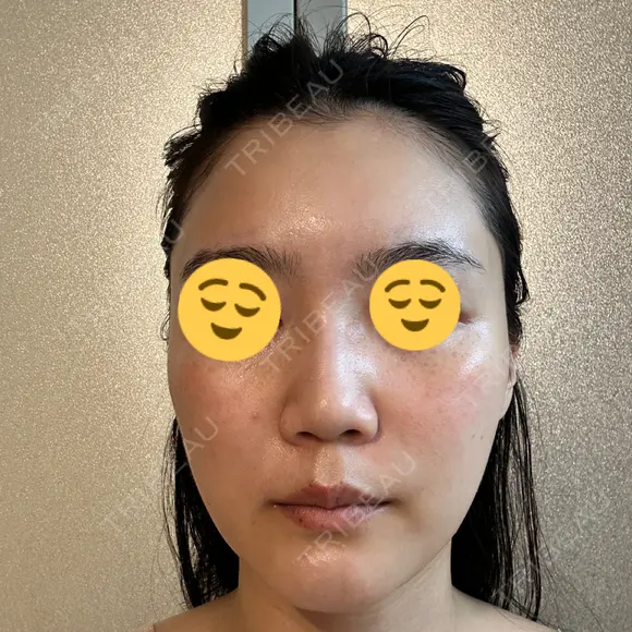 エレクトロポレーション / 光治療（フォトフェイシャルなど） DMTC CLINIC 日本橋院 DAY 4 メイン用