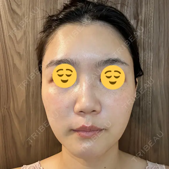 エレクトロポレーション / 光治療（フォトフェイシャルなど） DMTC CLINIC 日本橋院 DAY 5 メイン用