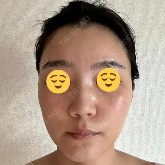 エレクトロポレーション / 光治療（フォトフェイシャルなど） DMTC CLINIC 日本橋院 DAY 7 メイン用