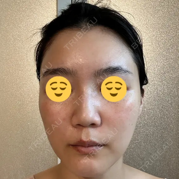 エレクトロポレーション / 光治療（フォトフェイシャルなど） DMTC CLINIC 日本橋院 DAY 9 メイン用