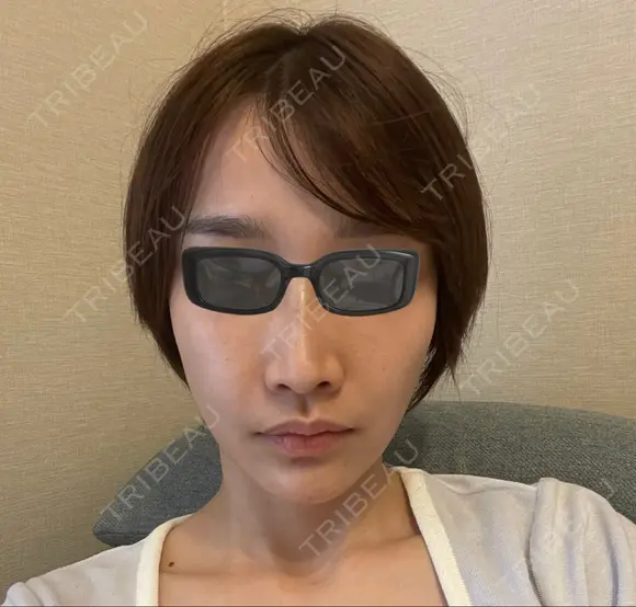 レーザートーニング（美白・肝斑） お肌のクリニック　高田馬場 AFTER メイン用