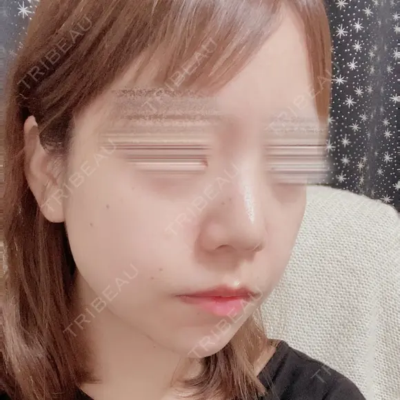 鼻尖形成（切開） / 軟骨移植 / ヒアルロン酸注入（鼻） / ヒアルロン酸注入（あご） ASTRA BEAUTY CLINIC DAY 3 メイン用